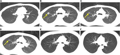 Case Report: Is Surgical Treatment Beneficial for Intracranial Basal Ganglia Cunninghamellamycosis Following Haematopoietic Stem Cell Transplantation?